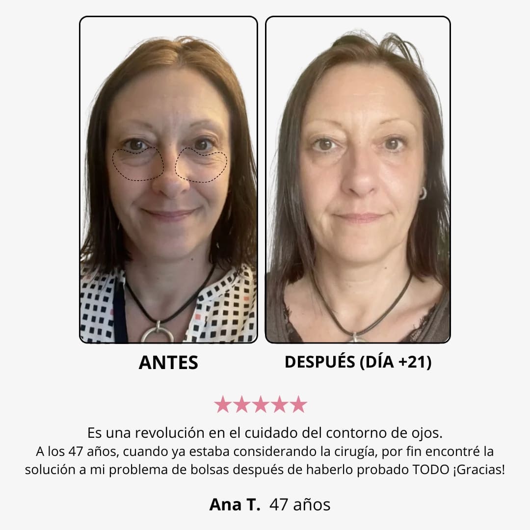 Crema de luz roja “eliminar ojos cansados”